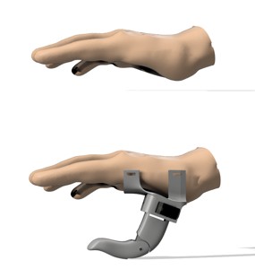 LOW COST PROFESSIONAL PROSTHESIS WITH ROBOTIC THUMB FOR AMPUTED RIGHT HAND - LOW COST PROFESSIONAL PROSTHESIS WITH ROBOTIC THUMB FOR AMPUTATED RIGHT HAND